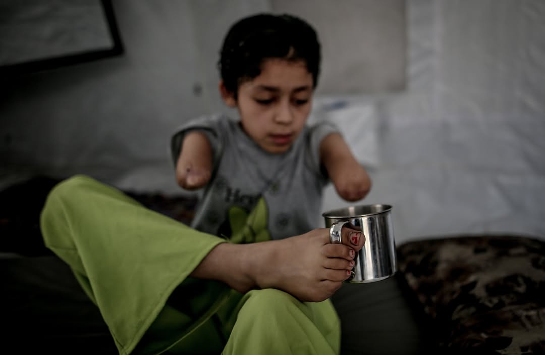 Young Gaza Girl Adapts After Losing Arms in Airstrike