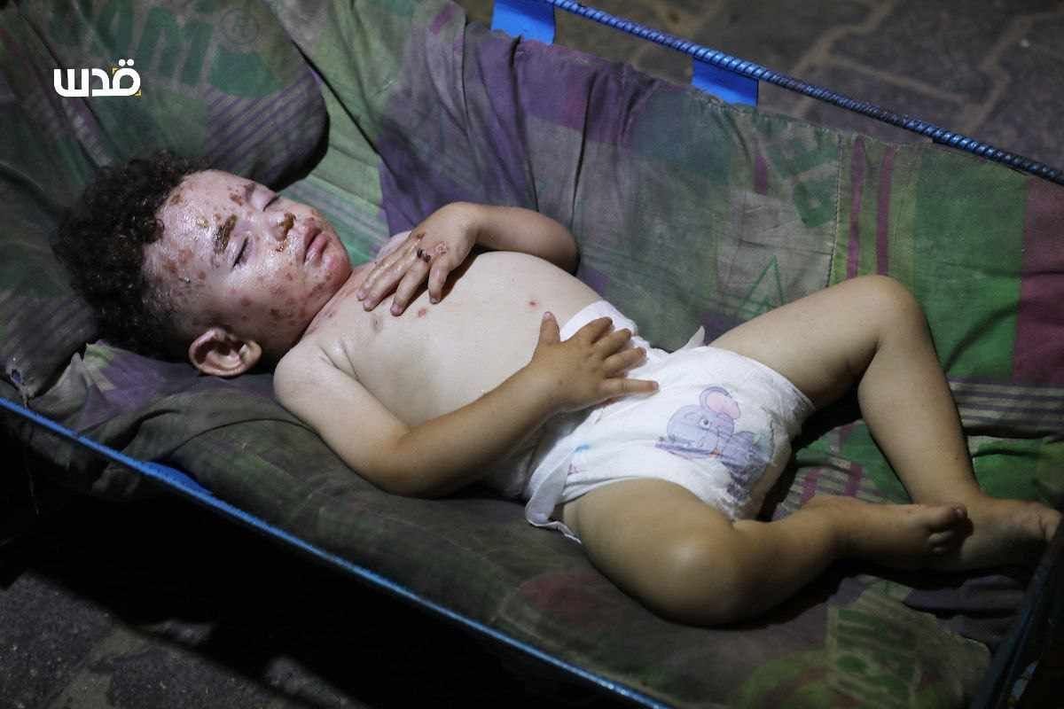 Palestinian Child Siraj Al-Samouni Fights Illness in Gaza Displacement