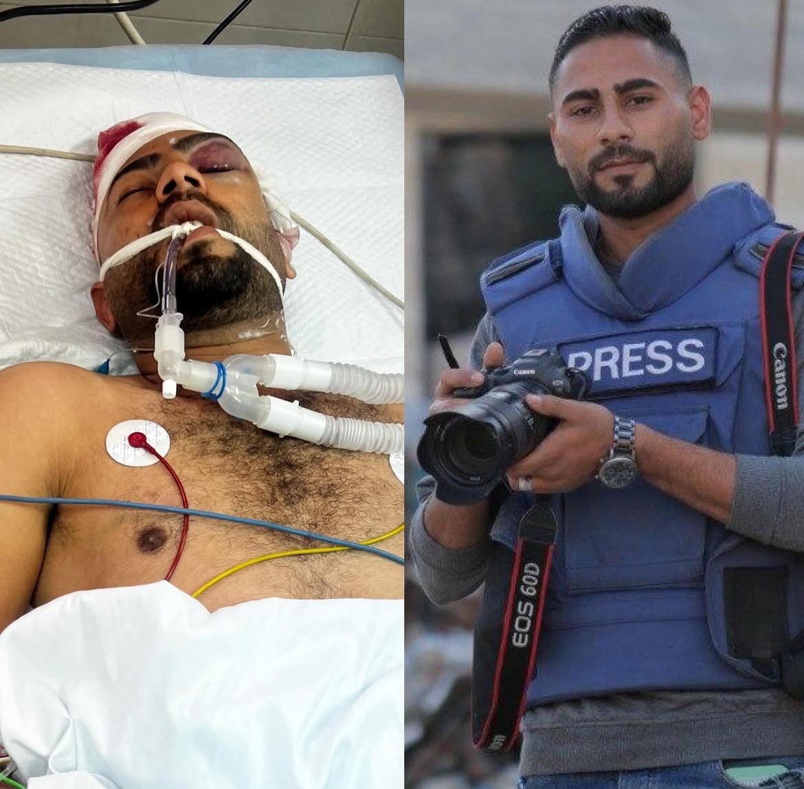 Journalist Ihab Al-Bardini in Critical Condition After Shrapnel Injury