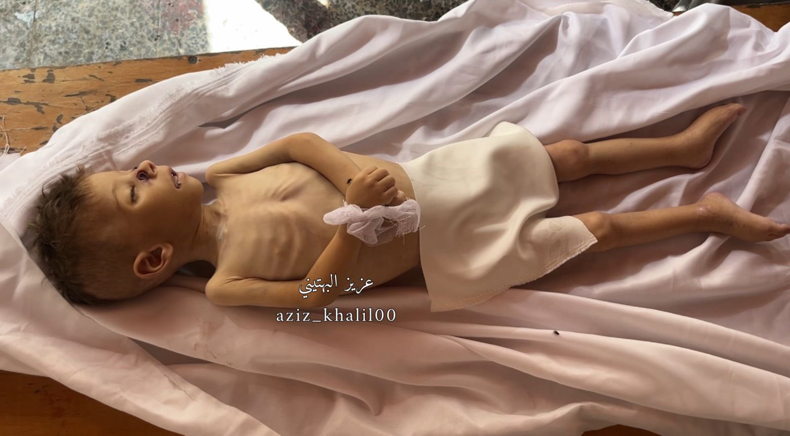 Young Child Saif Hellis Dies from Acute Malnutrition