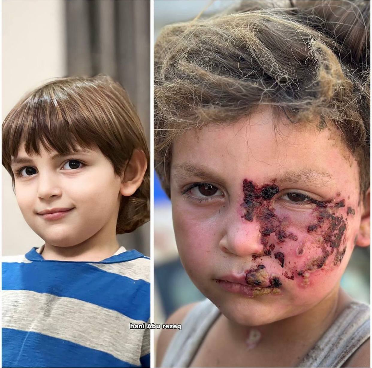Palestinian Child Severely Injured in Israeli Bombing of Gaza School