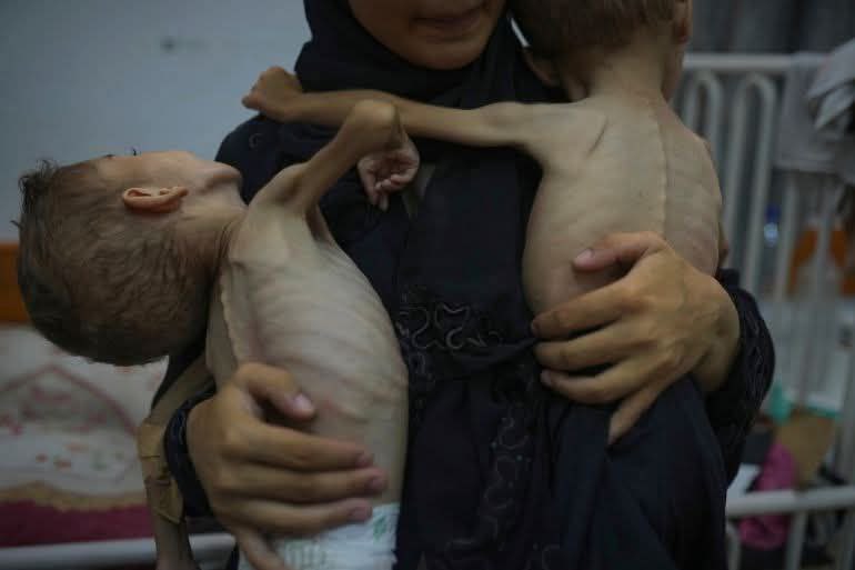 Gaza Malnutrition Deaths: 212 Total Including 98 Children