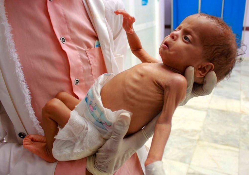 31 Deaths in Gaza from Malnutrition and Drought