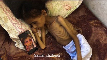 Gaza Children Facing Severe Hunger and Malnutrition Crisis
