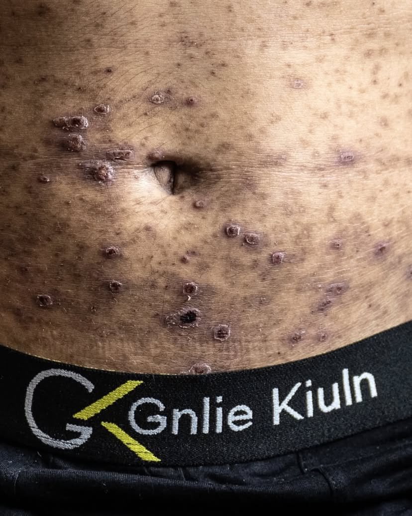 Jerusalemite boy Reda Obeid released with scabies effects