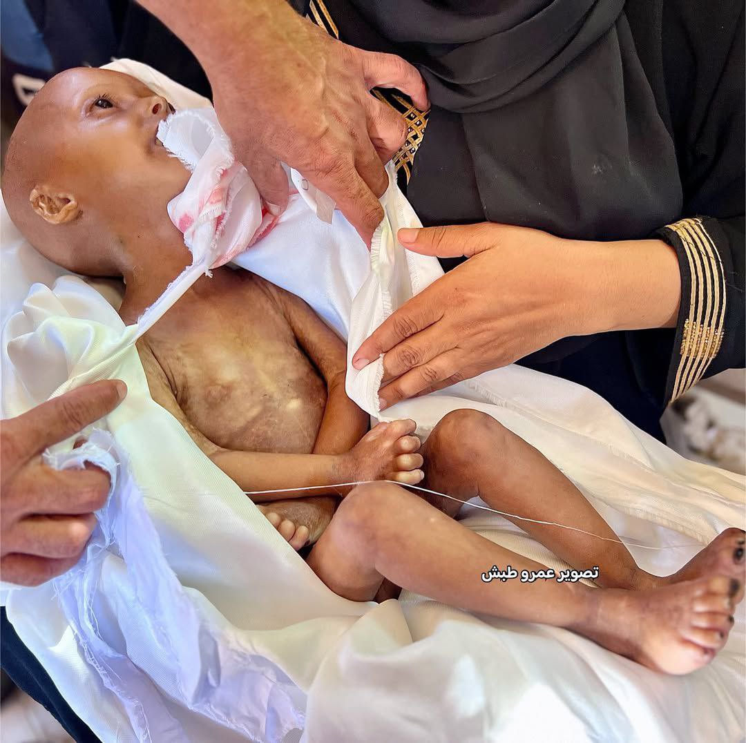 Four-Year-Old Girl Dies from Malnutrition in Gaza Blockade