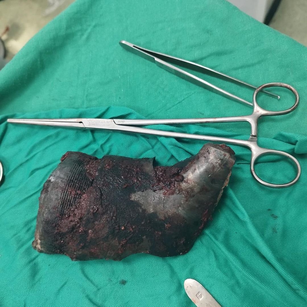 One kilogram shrapnel removed from elderly man’s shoulder Gaza