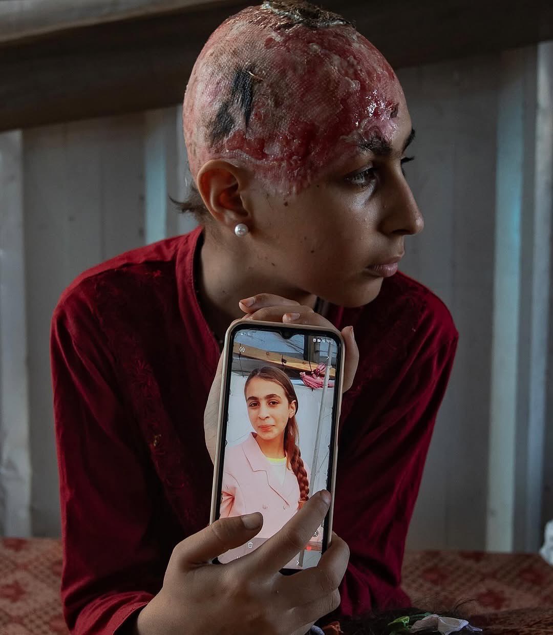 Child injured in airstrike urgently needs medical evacuation from Gaza