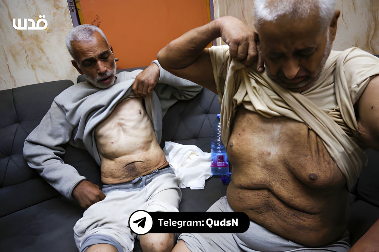 Released Palestinian Prisoners Show Signs of Torture and Mistreatment