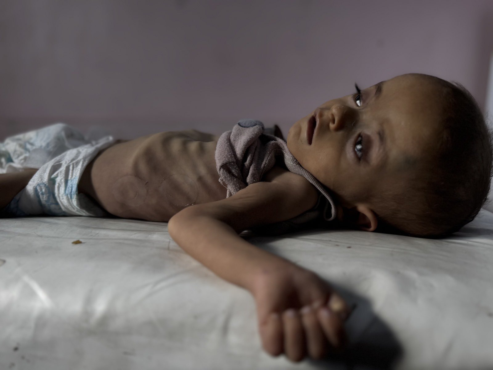 Child Death from Malnutrition in Gaza Conflict Zone