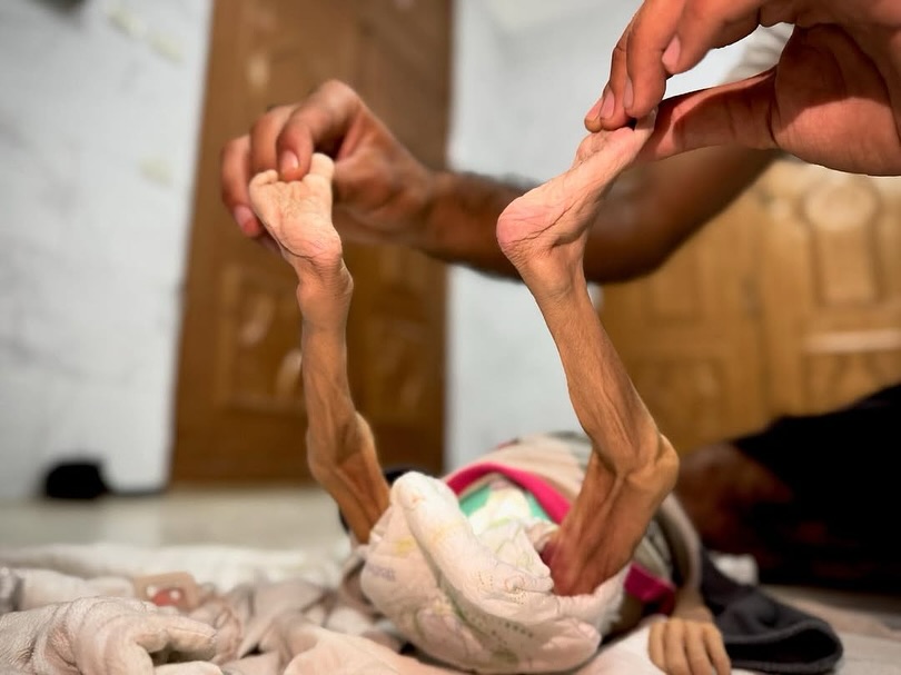 Gaza hospitals report seven deaths from hunger malnutrition