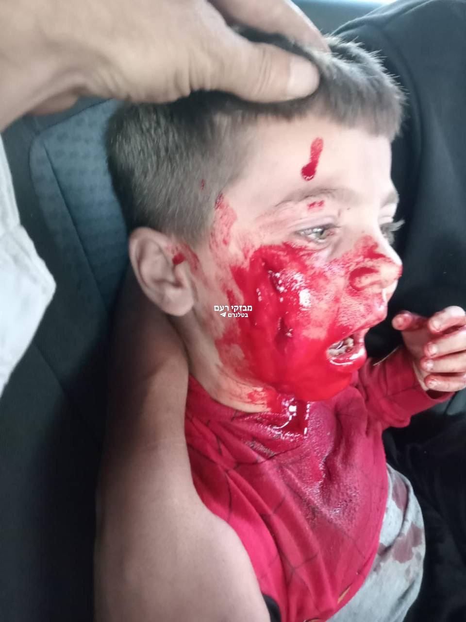 Palestinian Child Wounded in West Bank Settler Attack