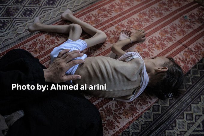 Medical Crisis in Gaza: Malnutrition and Vulnerable Populations