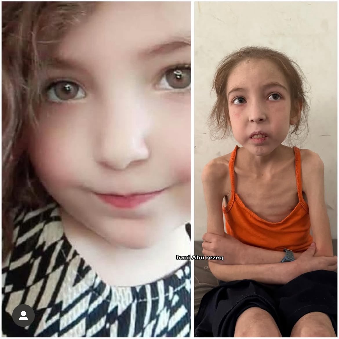 Urgent medical evacuation needed for malnourished 12-year-old girl