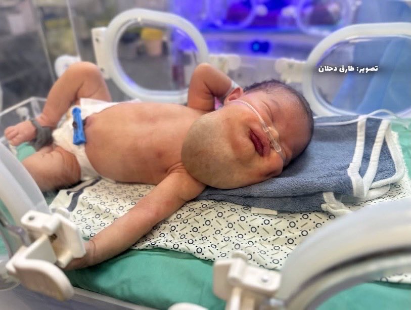 Three-week-old Du’a Qashta needs urgent throat tumor treatment abroad