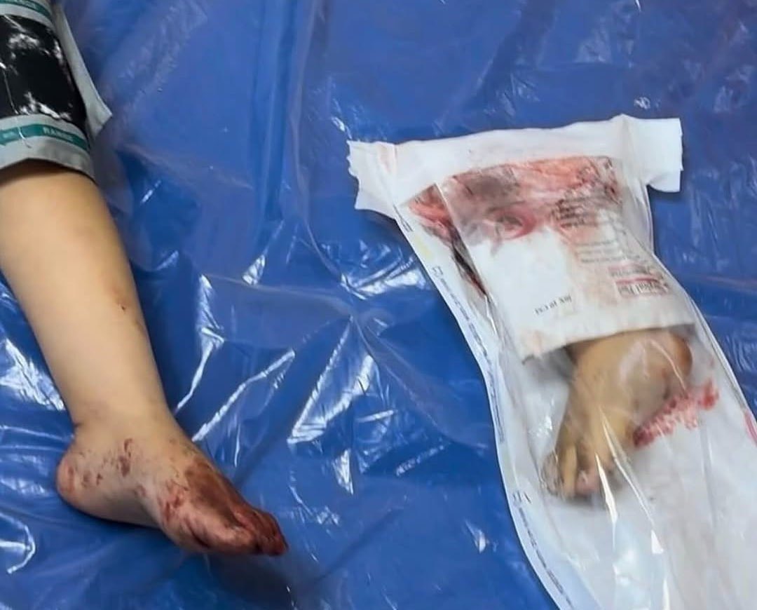 Israeli airstrikes in Gaza injure child civilian populations