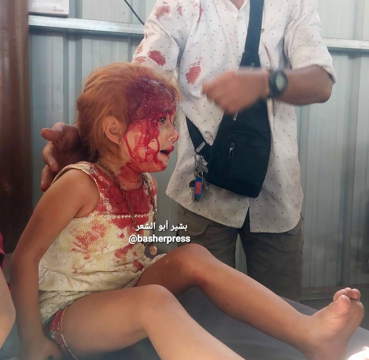 Injured Palestinian Girl Amid Israeli Bombardment in Gaza