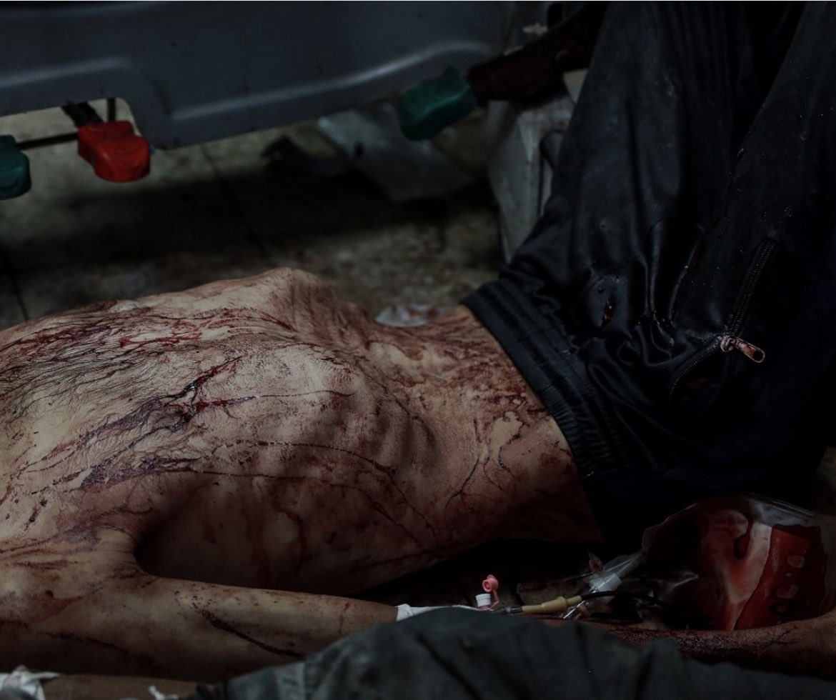 Palestinian injured from severe hunger arrives at Nasser Hospital