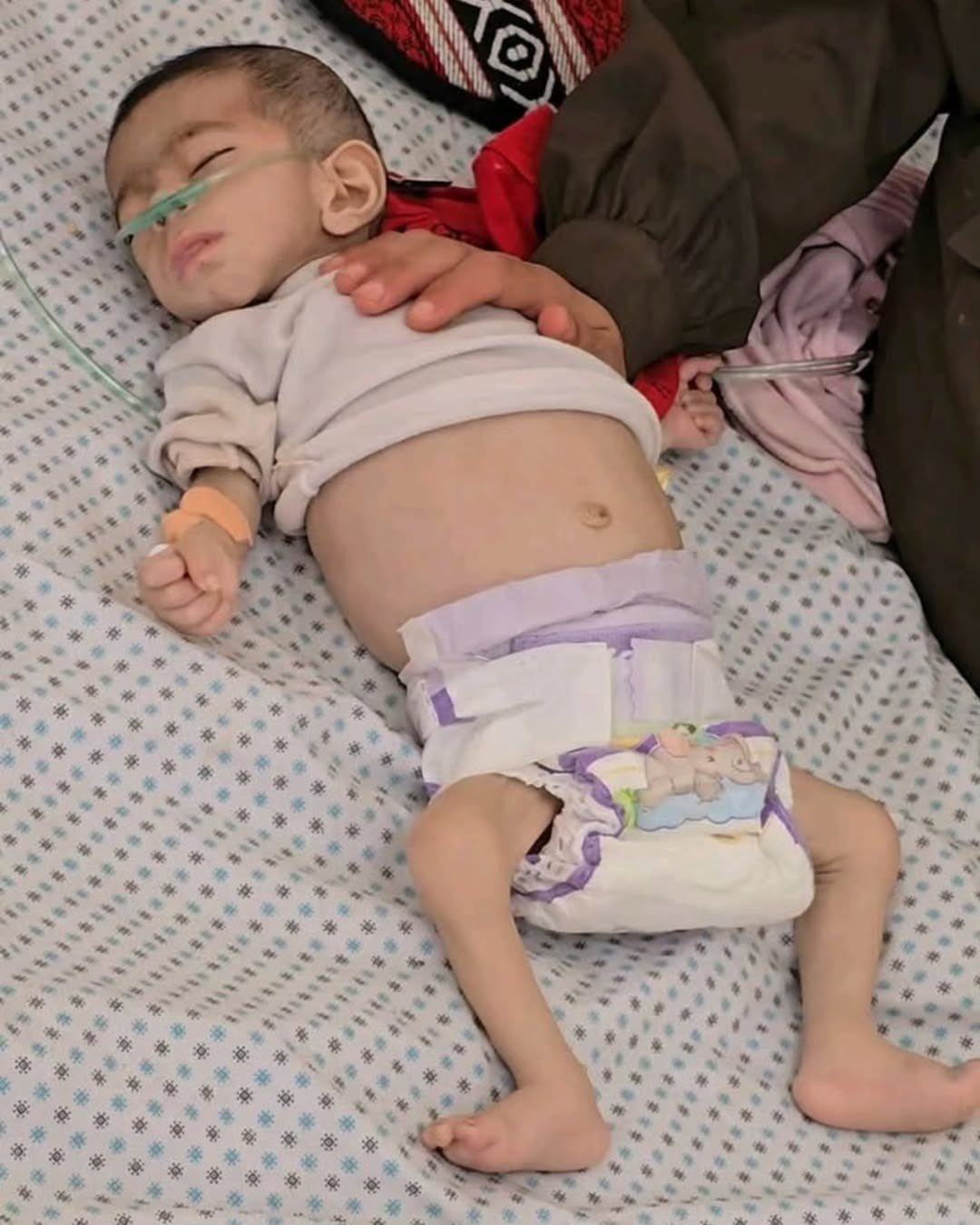 Child Dies from Malnutrition at Al-Rantisi Hospital Gaza