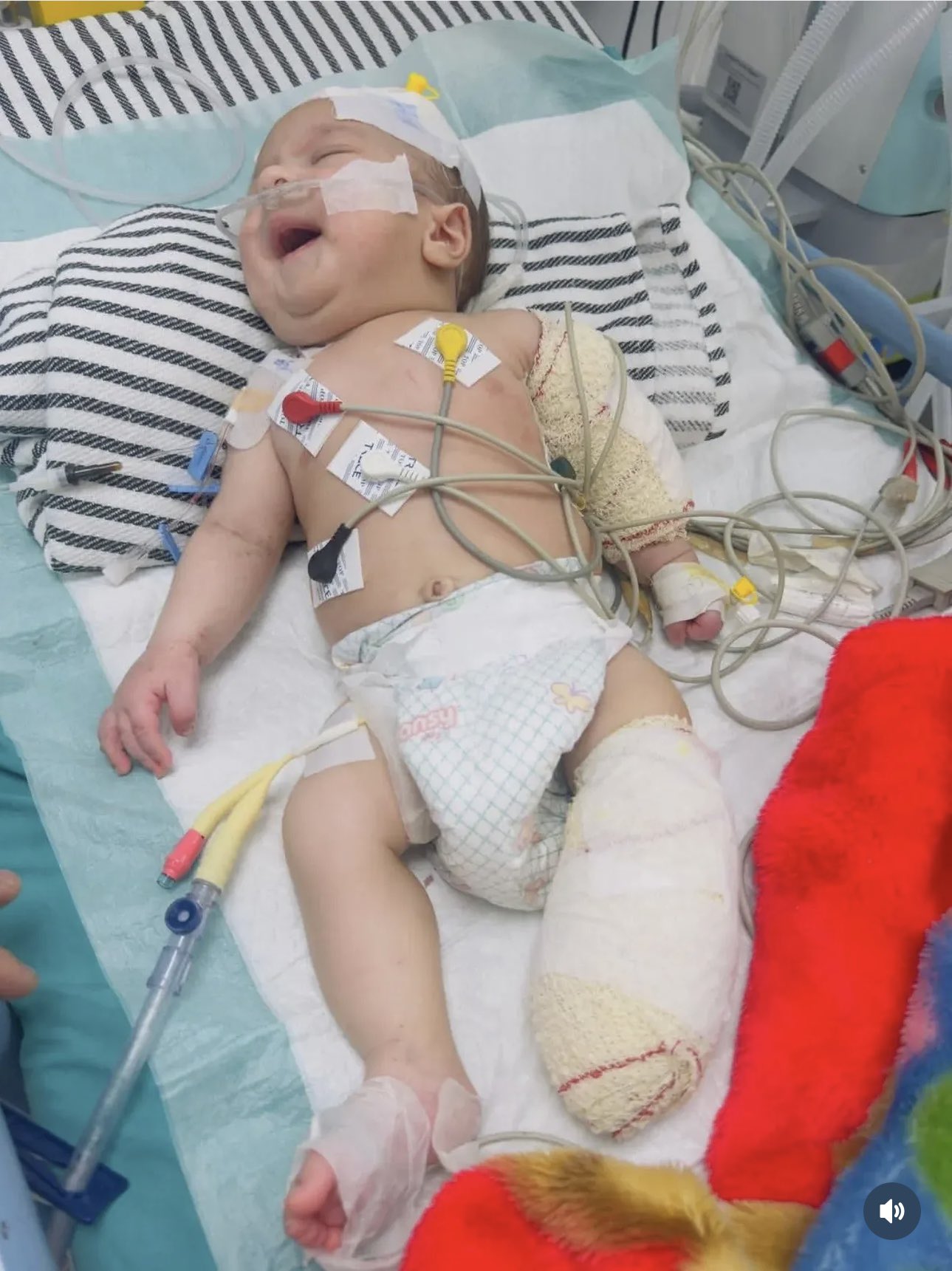 50-day-old infant risking another amputation