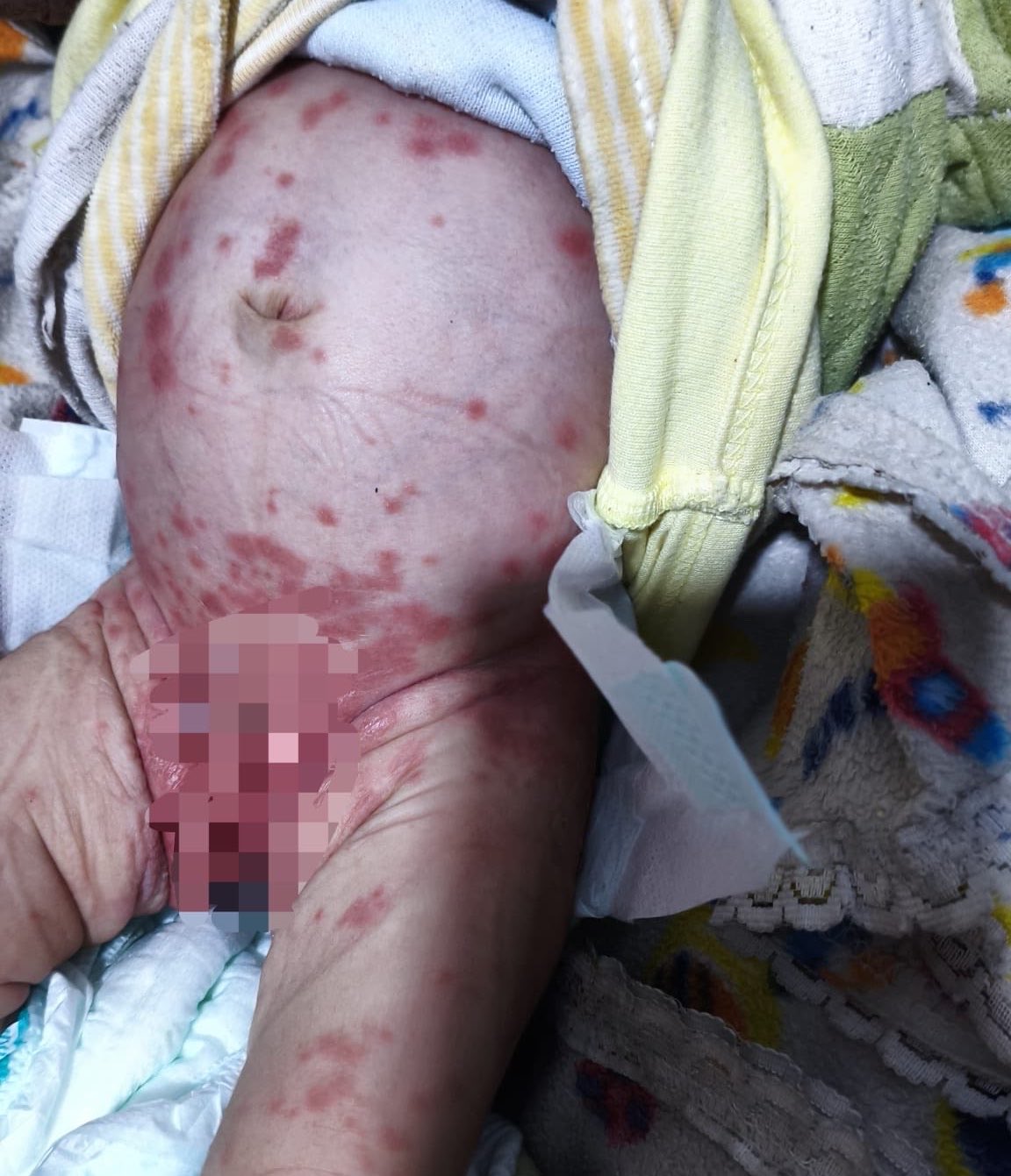 Mother in Gaza pleads for ‘any cream’ for malnourished baby