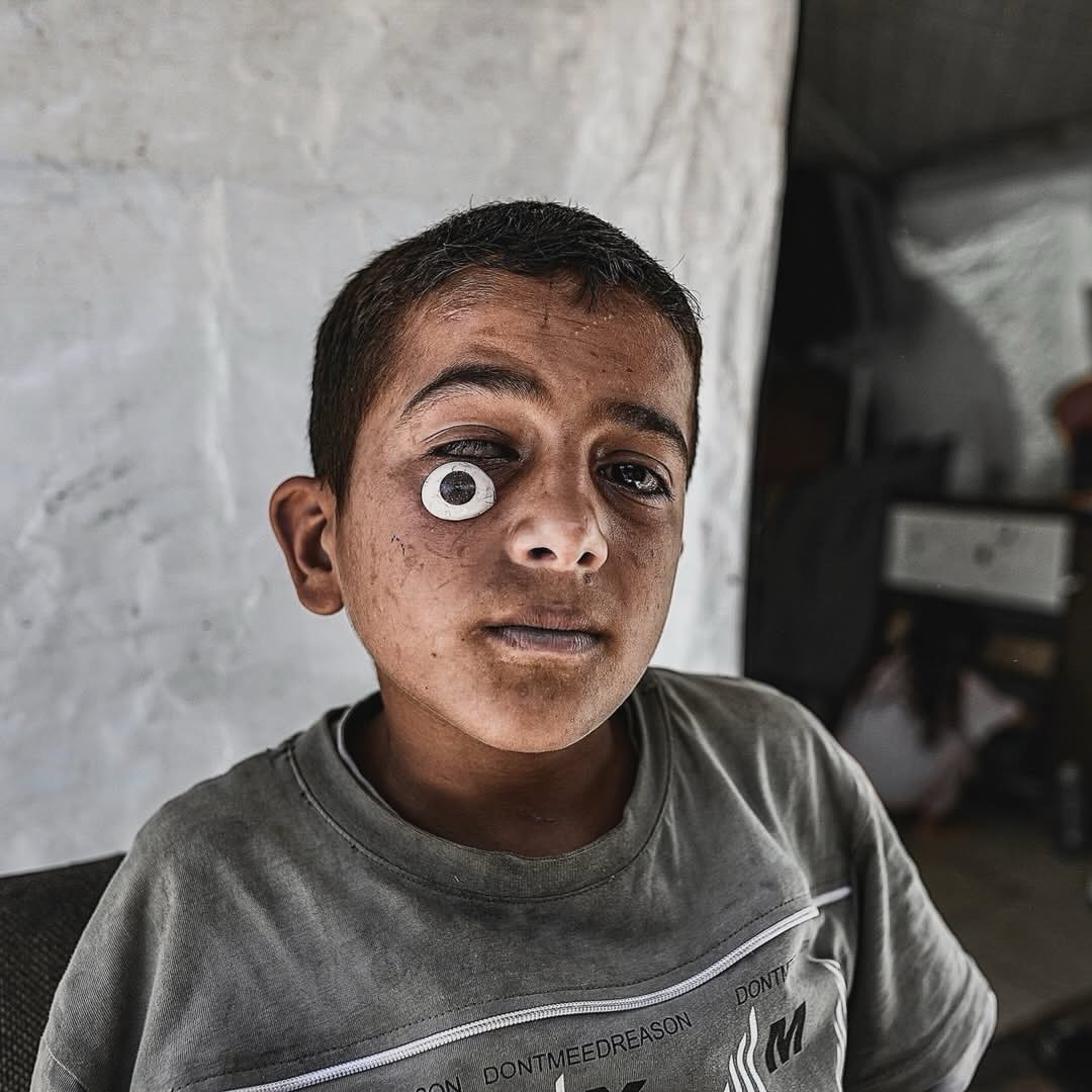 Mohammed loses sight in right eye after rifle butt blow