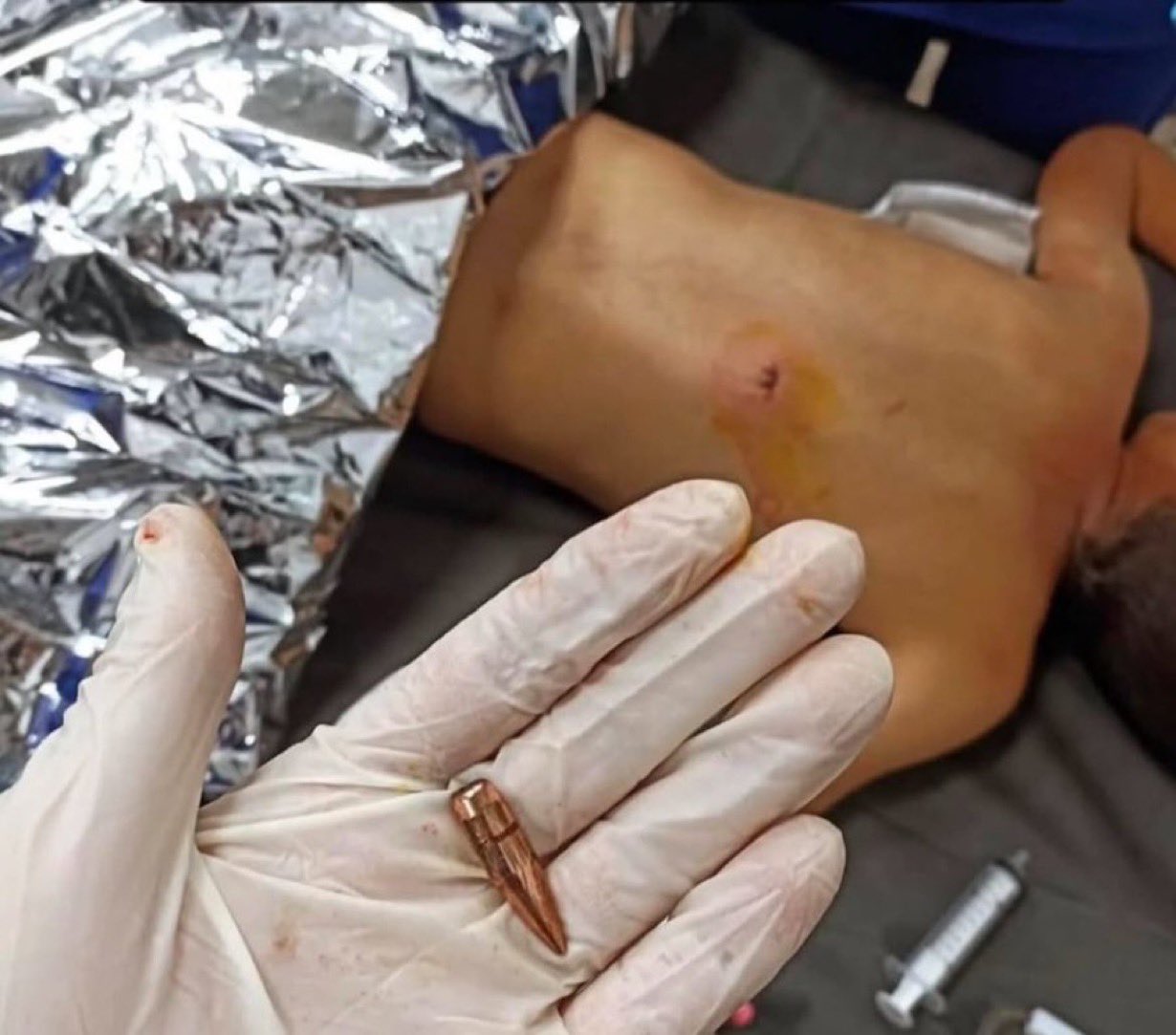 7-year-old Palestinian child paralyzed by Israeli drone bullet