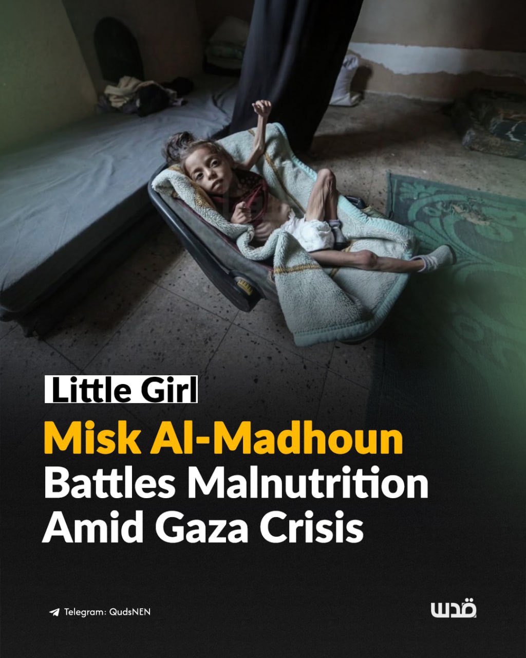Displaced Gaza girl Misk Al-Madhoun suffers malnutrition, cerebral palsy