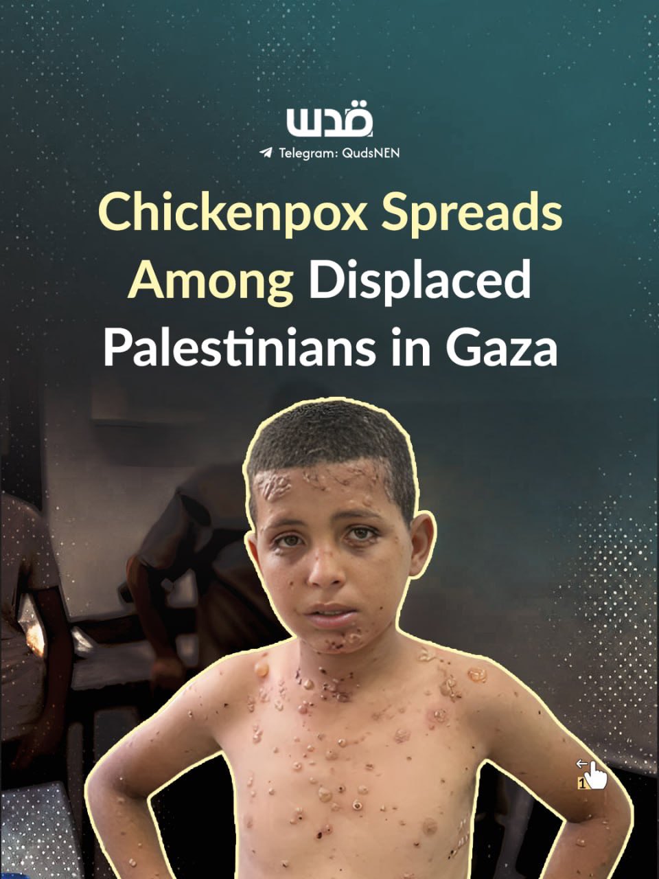 Health crisis spreads among displaced Palestinian children in Gaza shelters