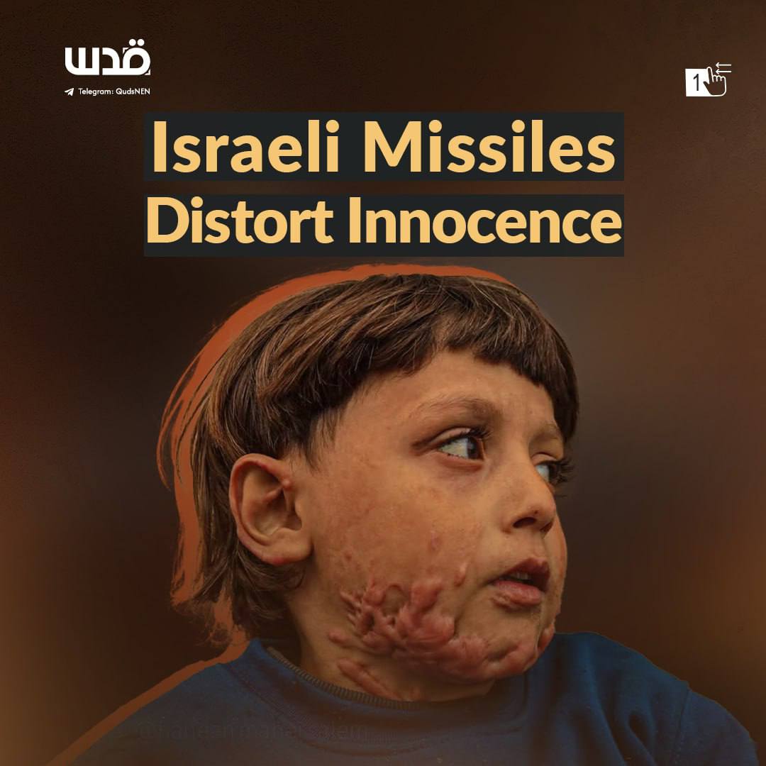 5-year-old Gazan boy severely burned in Israeli airstrike on Jabalia school