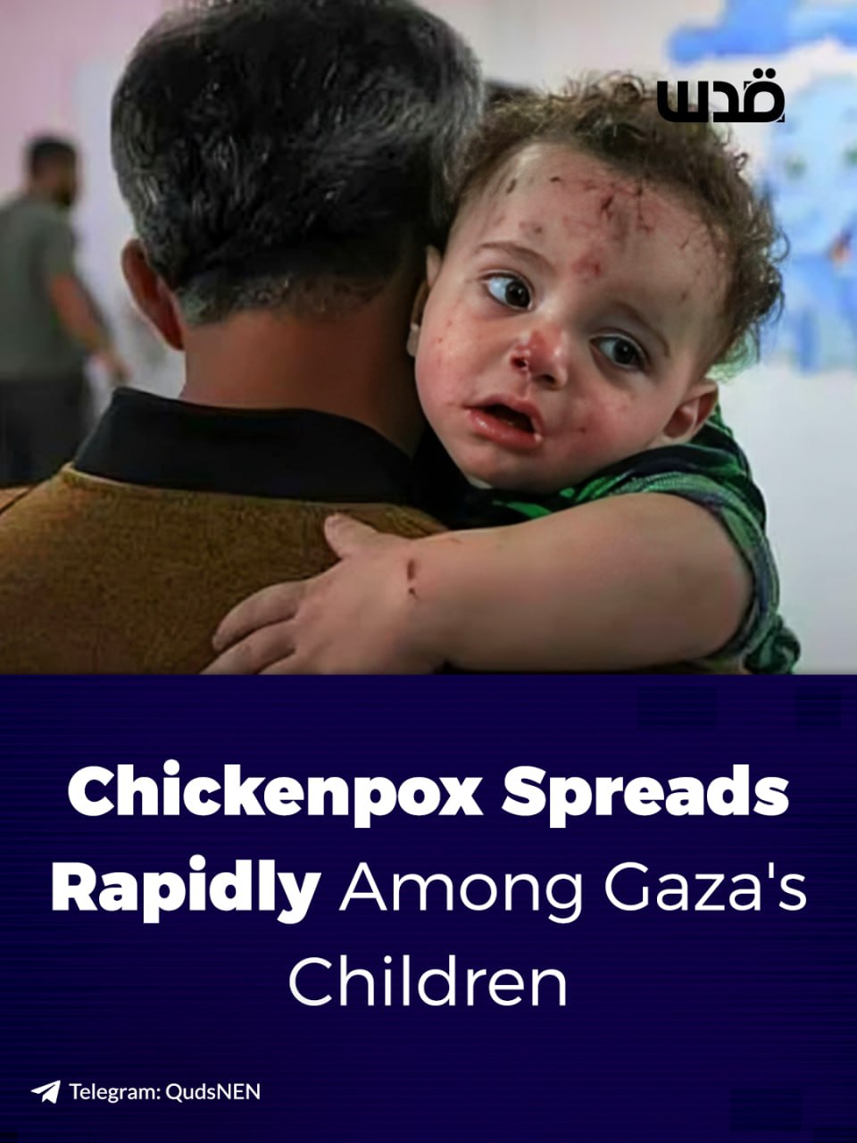 Gaza pediatrician reports 10,000 children diagnosed with chickenpox