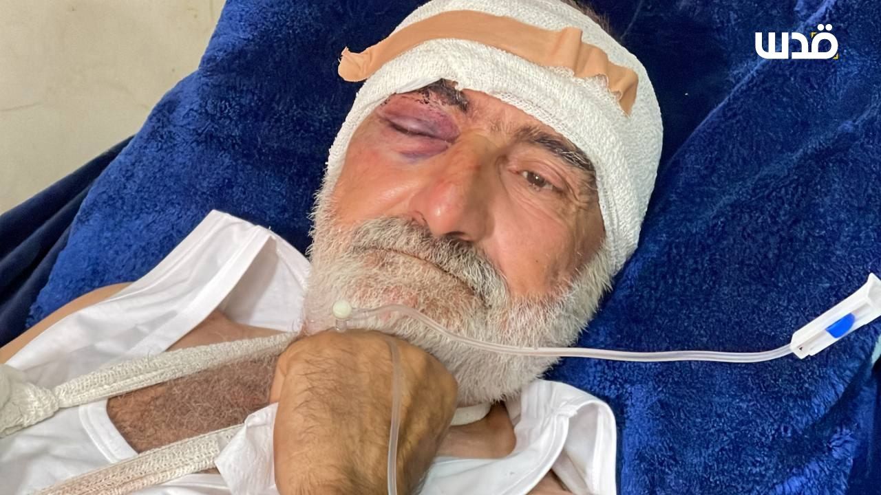 Palestinian man injured by Israeli settler attack in Jamma’in
