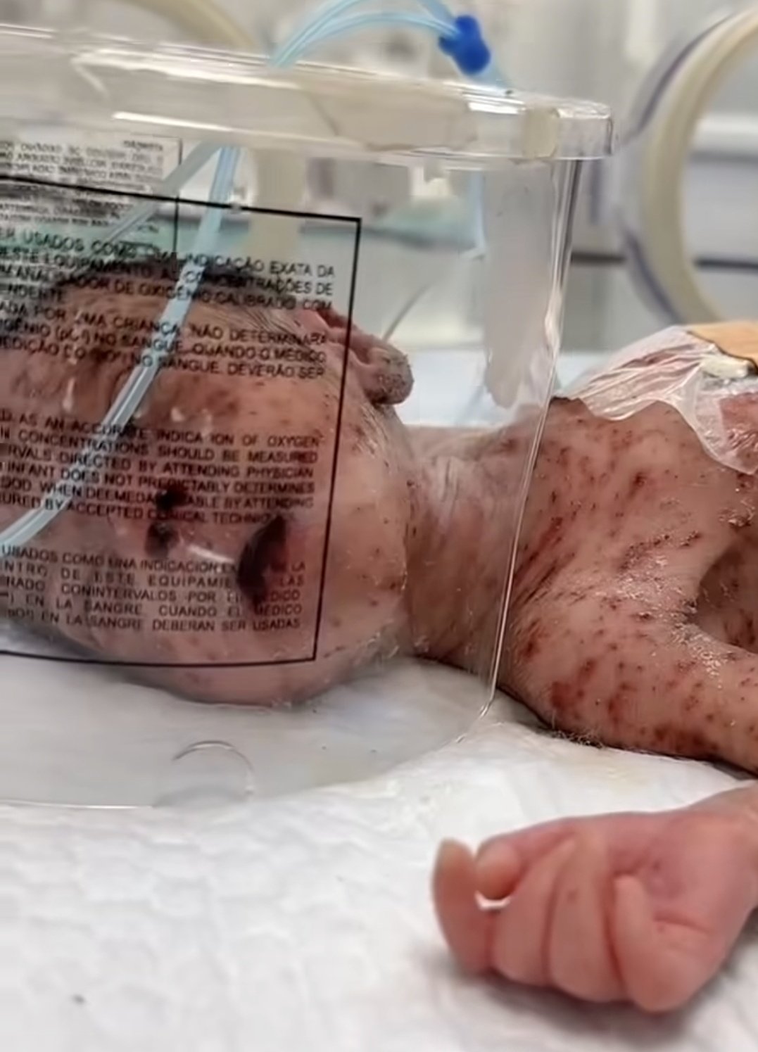 Newborn in Gaza battles chickenpox as medicine unavailable