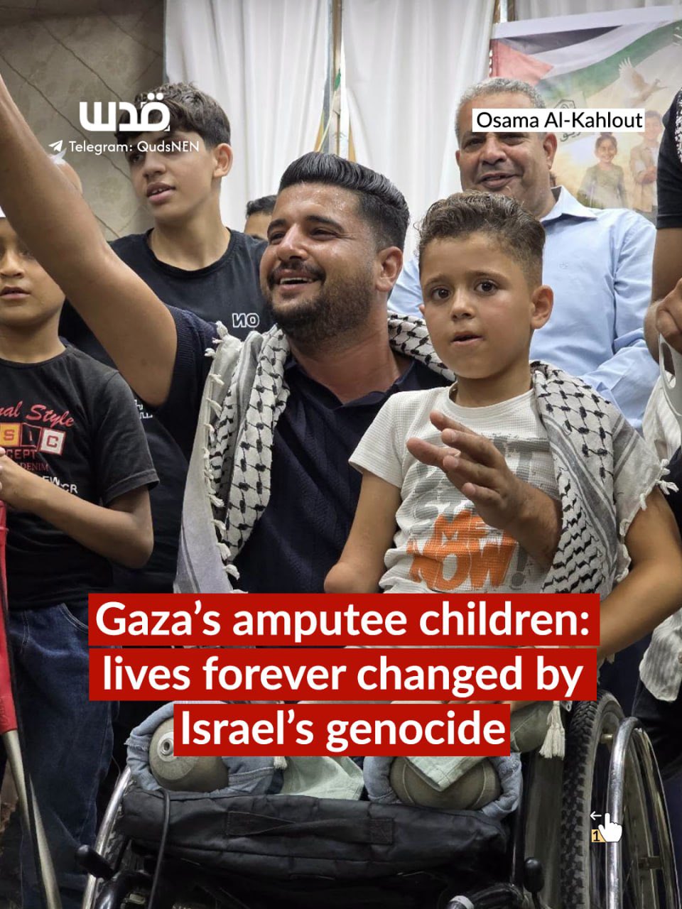 Palestinian children in Gaza lose limbs in Israel’s war