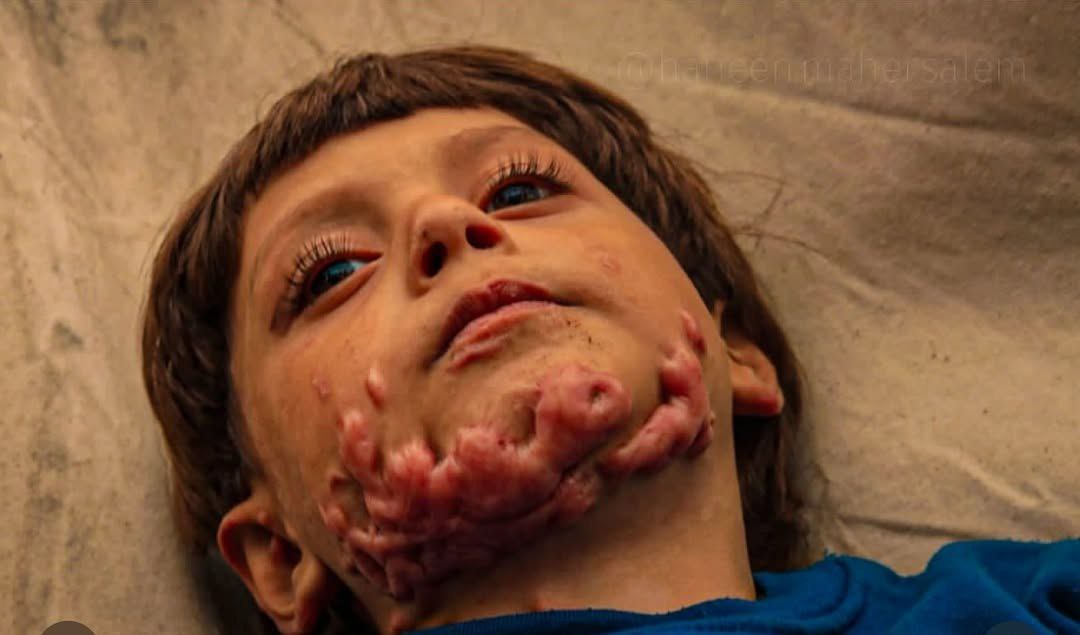 5-year-old Mohammad Marouf burned in Israeli strike on Jabalia school