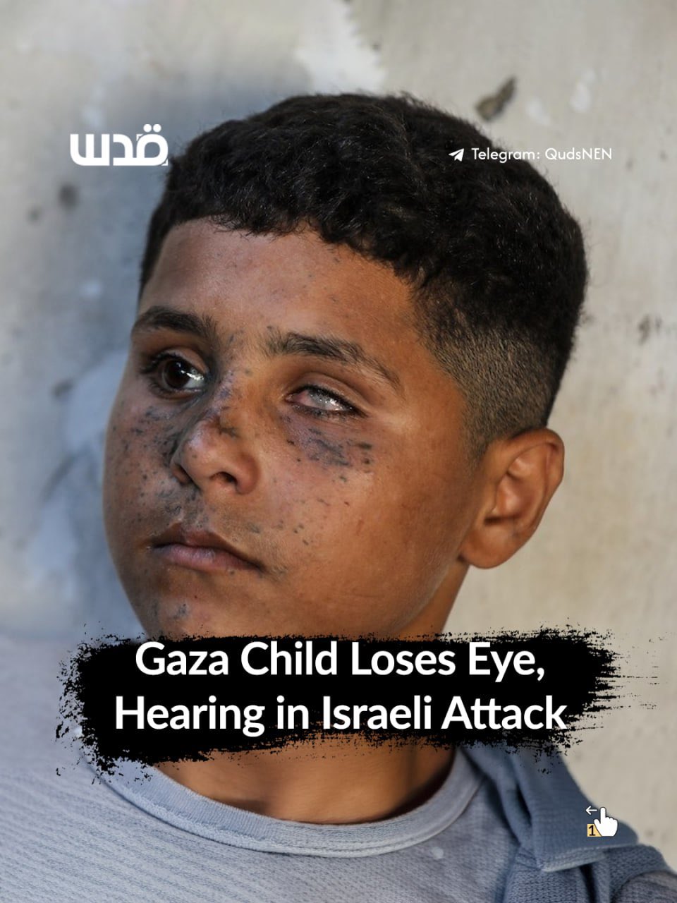 Palestinian child Adel Al-Ashi injured by Israeli artillery in Gaza