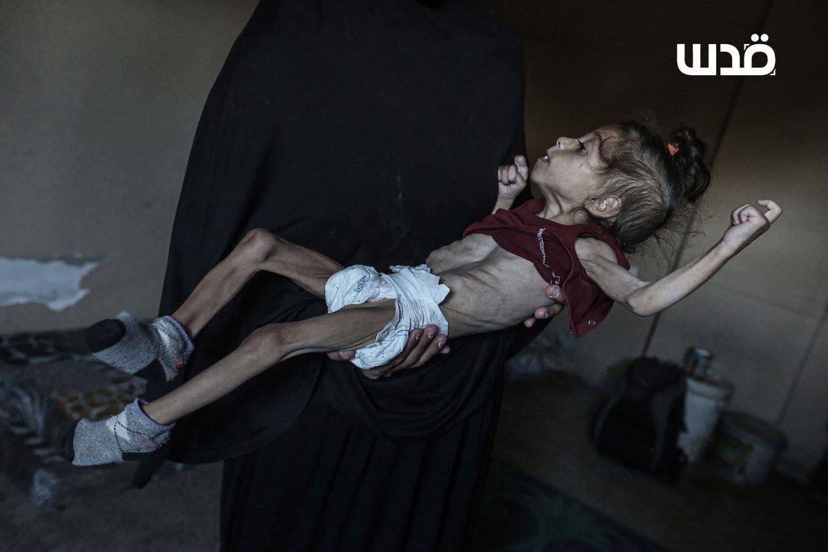 5-year-old Misk Al-Madhoun suffers atrophy and malnutrition under Gaza blockade