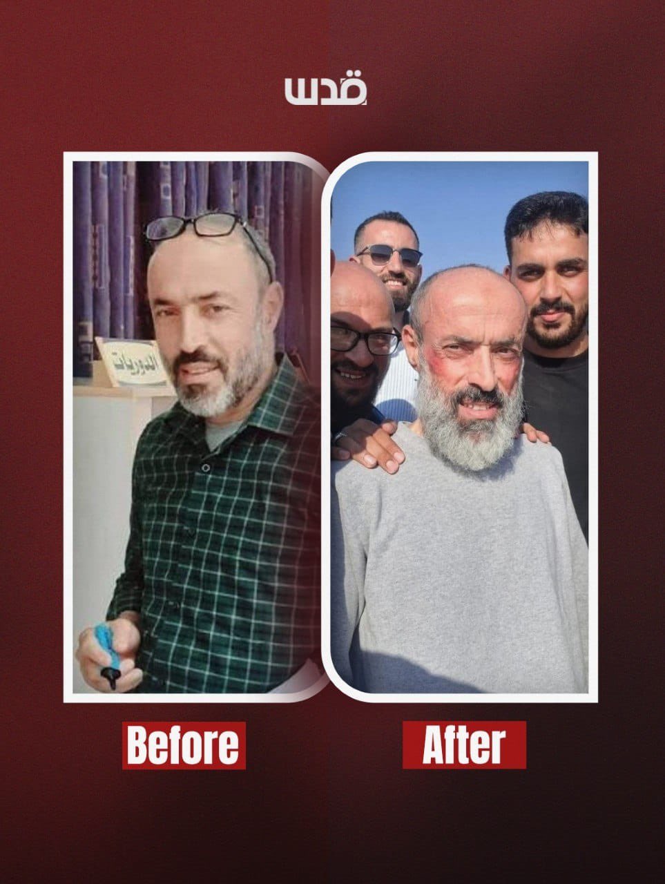 Palestinian detainee released from Israeli detention with torture marks