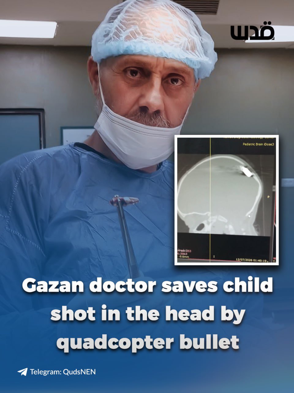 Gazan doctor removes bullet from toddler injured by quadcopter in Al-Maghazi