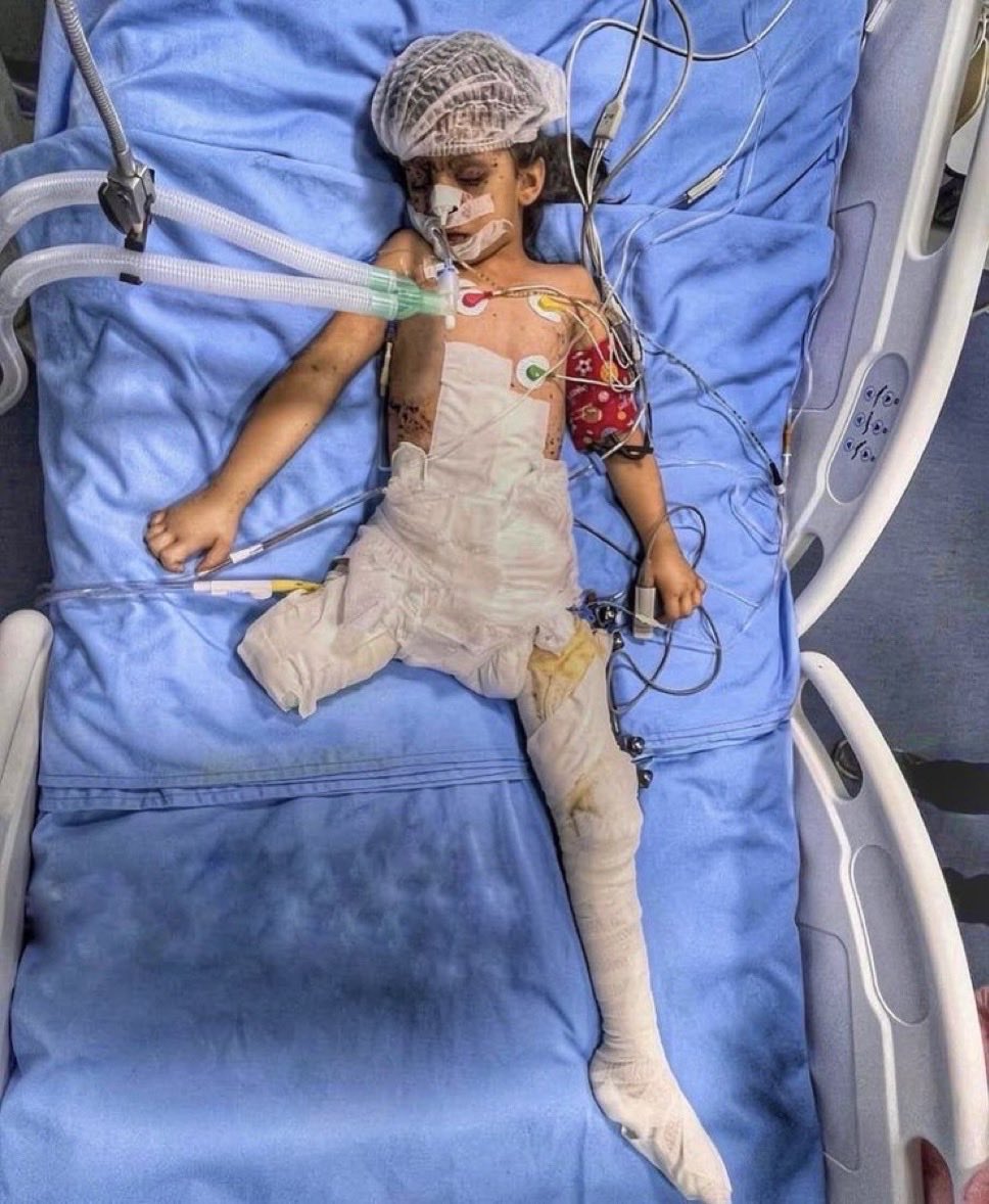 Gaza has largest number of child amputees in history