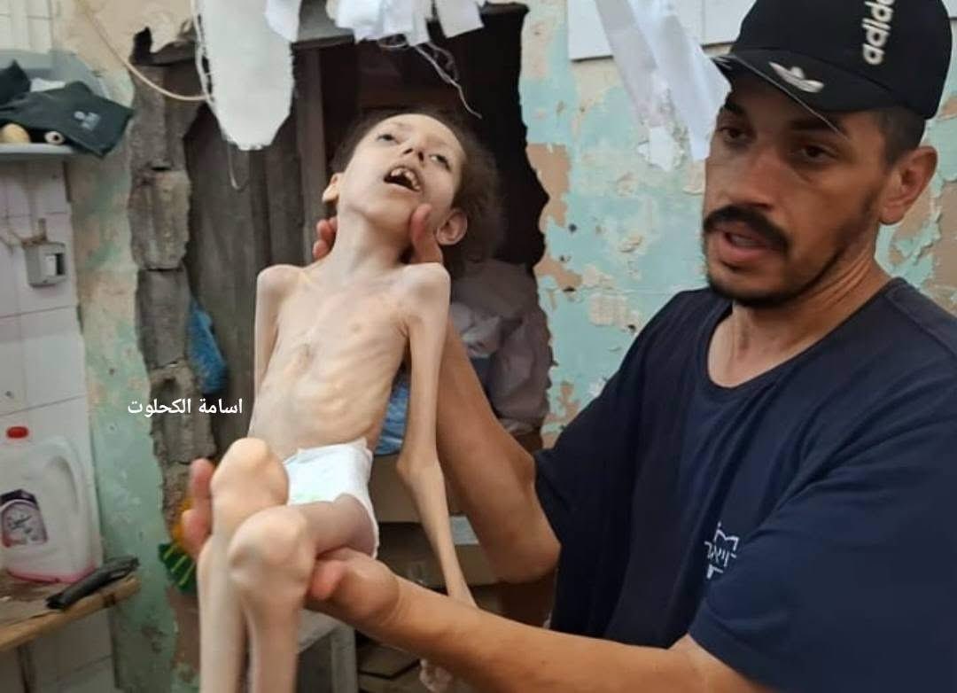 Child Maha Bashir dies of malnutrition in Deir al-Balah
