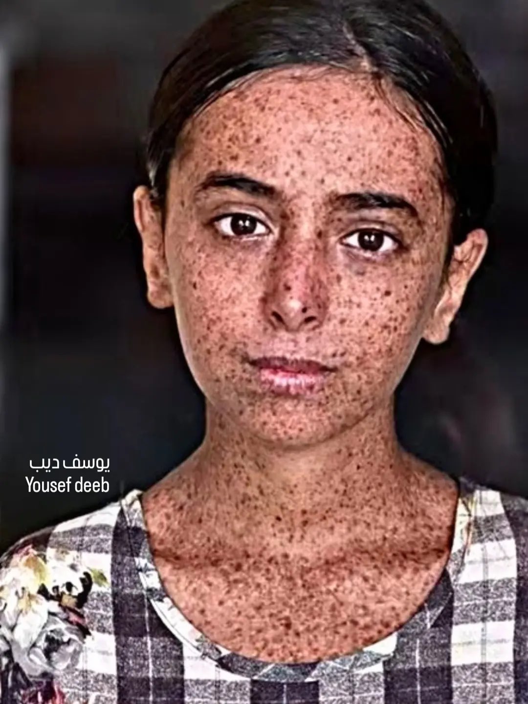 Gazan girl Mays Al-Qudra suffers as limited care harms her childhood