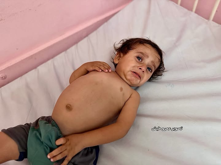 Toddler Mohammed Saqr suffers severe malnutrition in Gaza