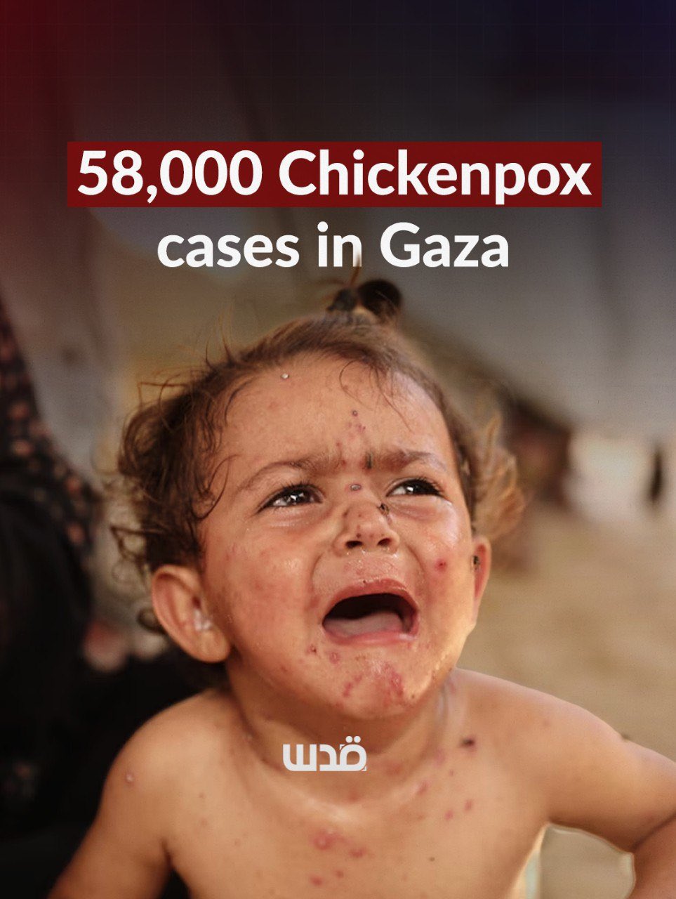 Gaza Health Ministry warns of chickenpox outbreak with 58,000 cases