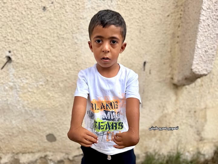Five-year-old Wajed Abu Awwad needs urgent thumb reconstruction surgery