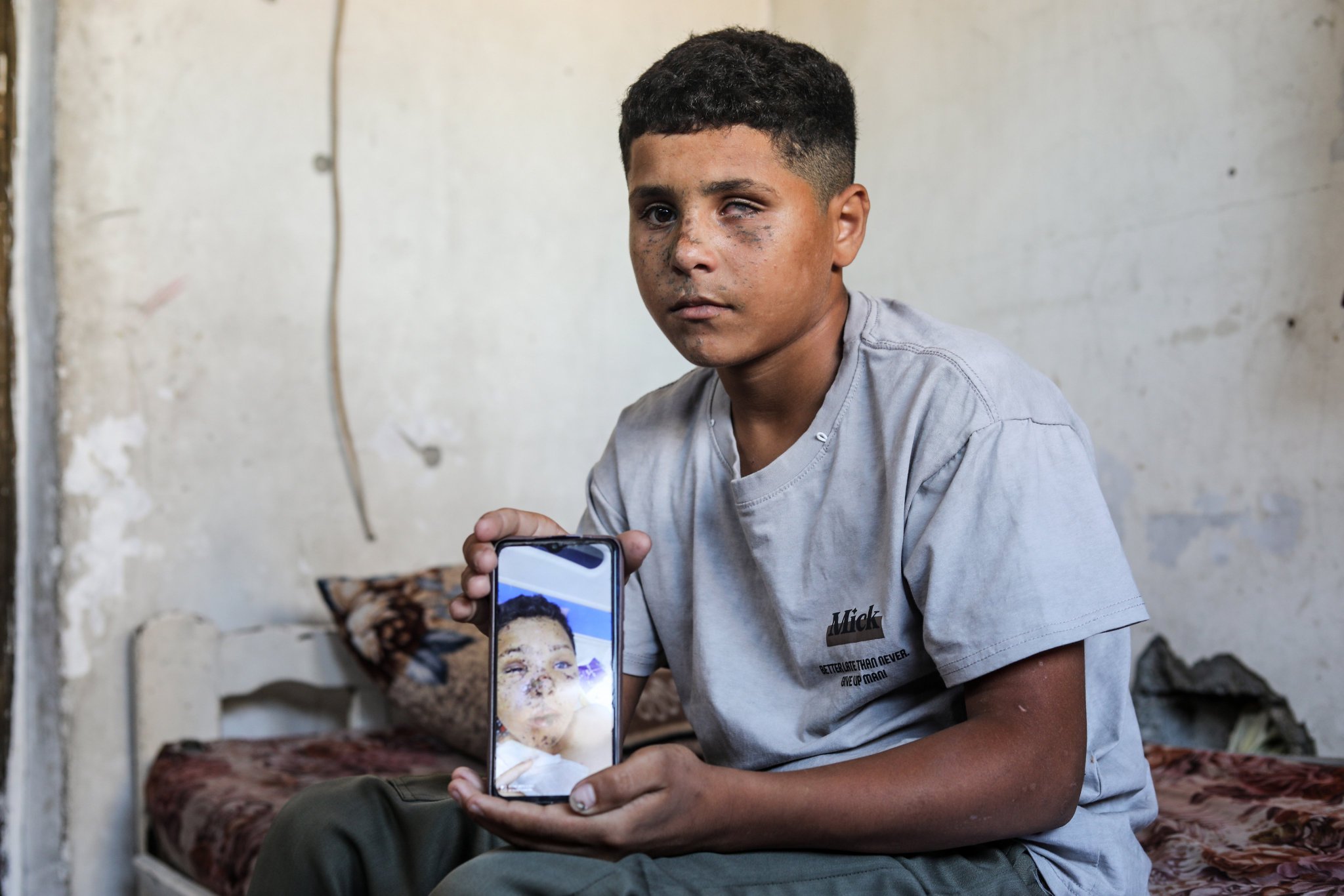 Boy, 13, loses eye and hearing in Israeli strike in Gaza