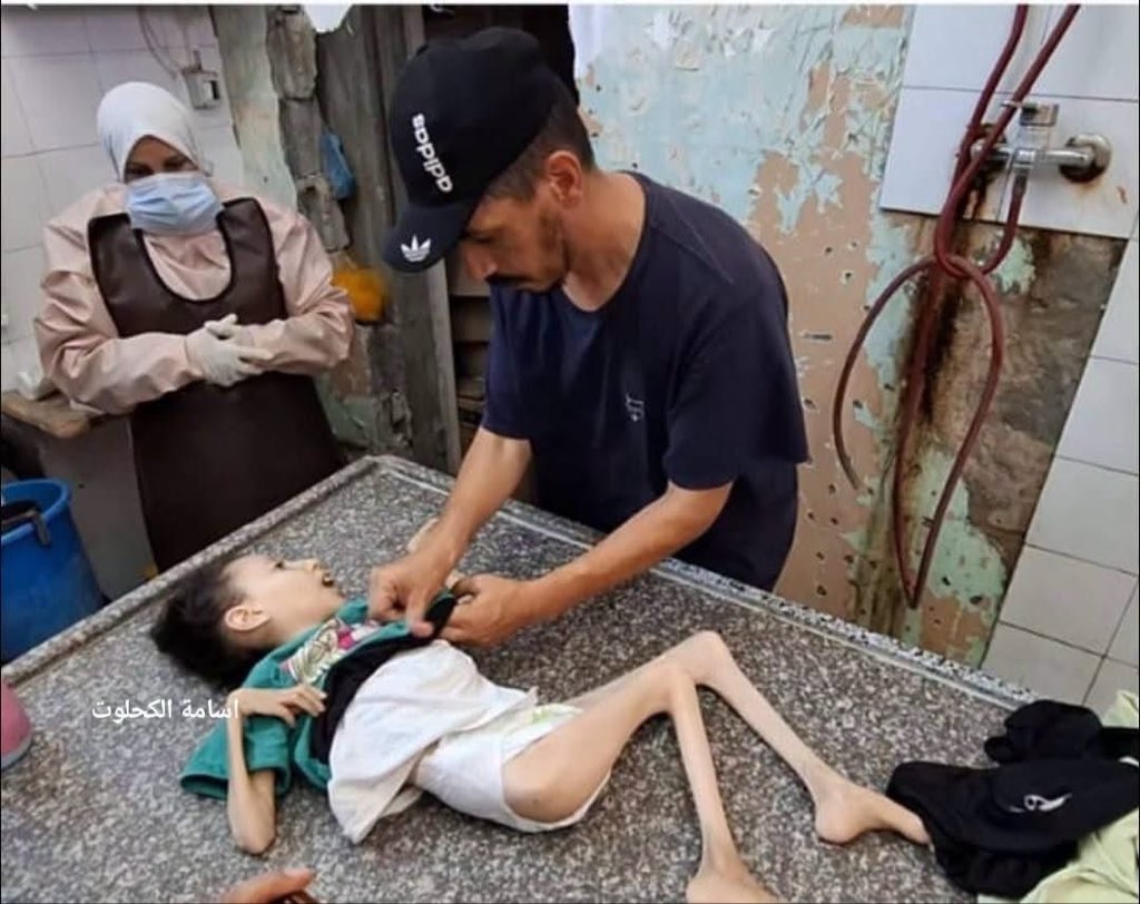 Gaza children dying from malnutrition amid Israeli starvation