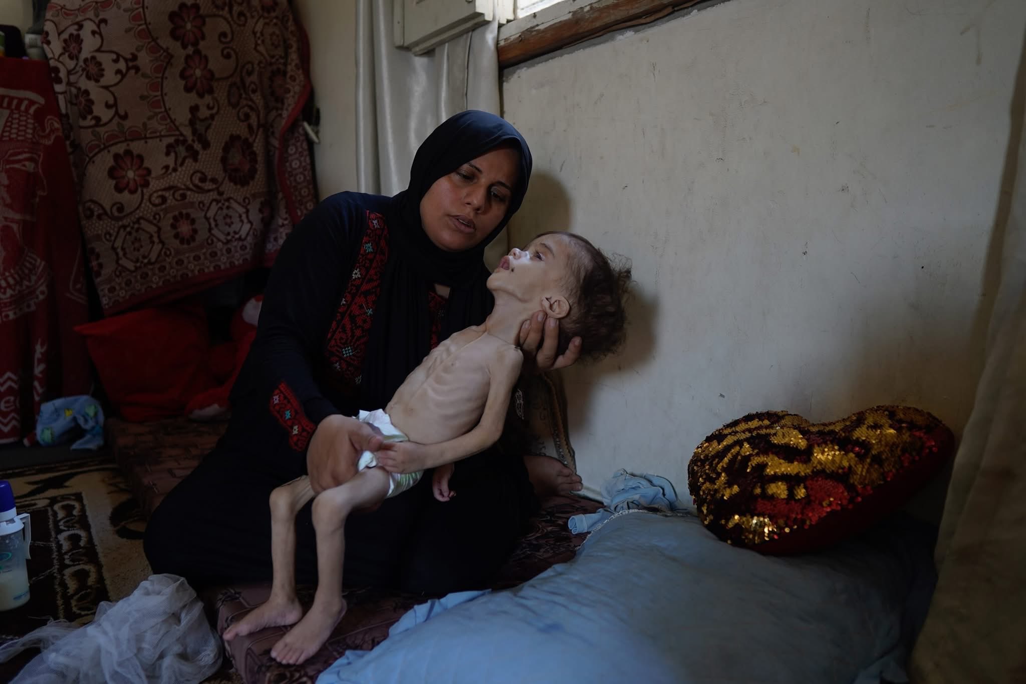 Gaza toddler Essam Al-Nabih suffers severe malnutrition and hydrocephalus