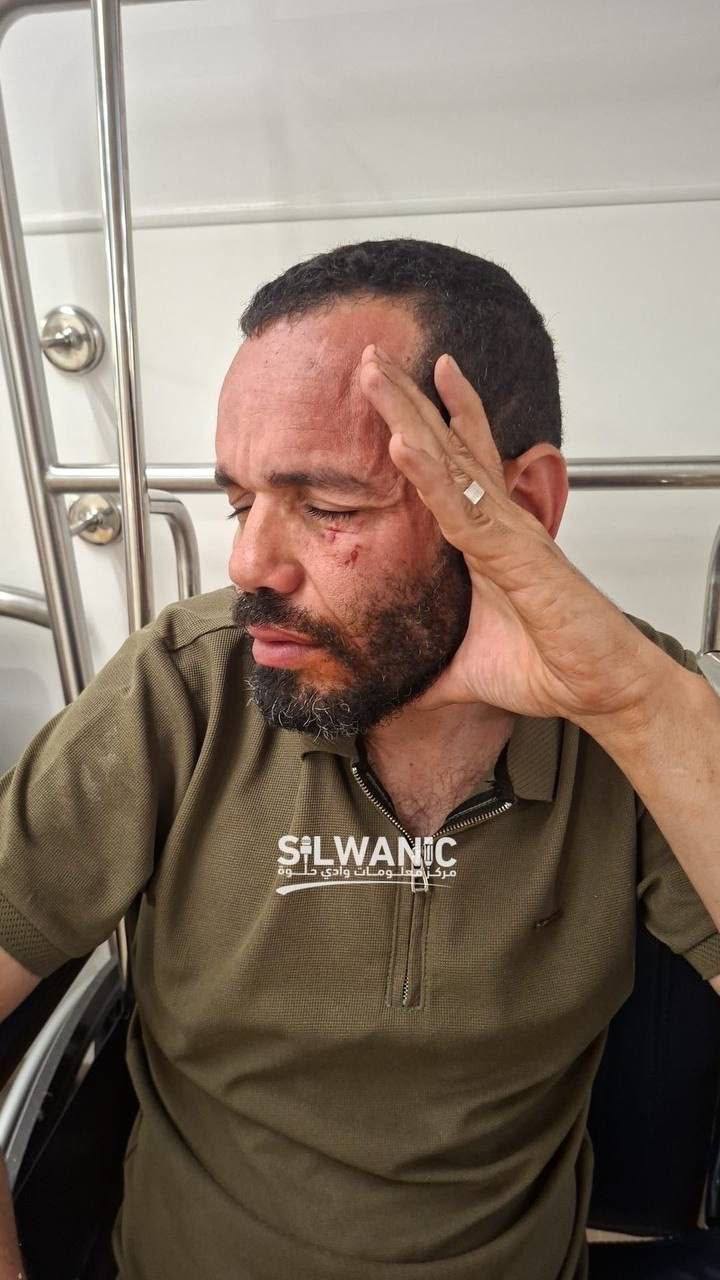 Palestinian man burned in settler pepper-spray attack in Shuafat
