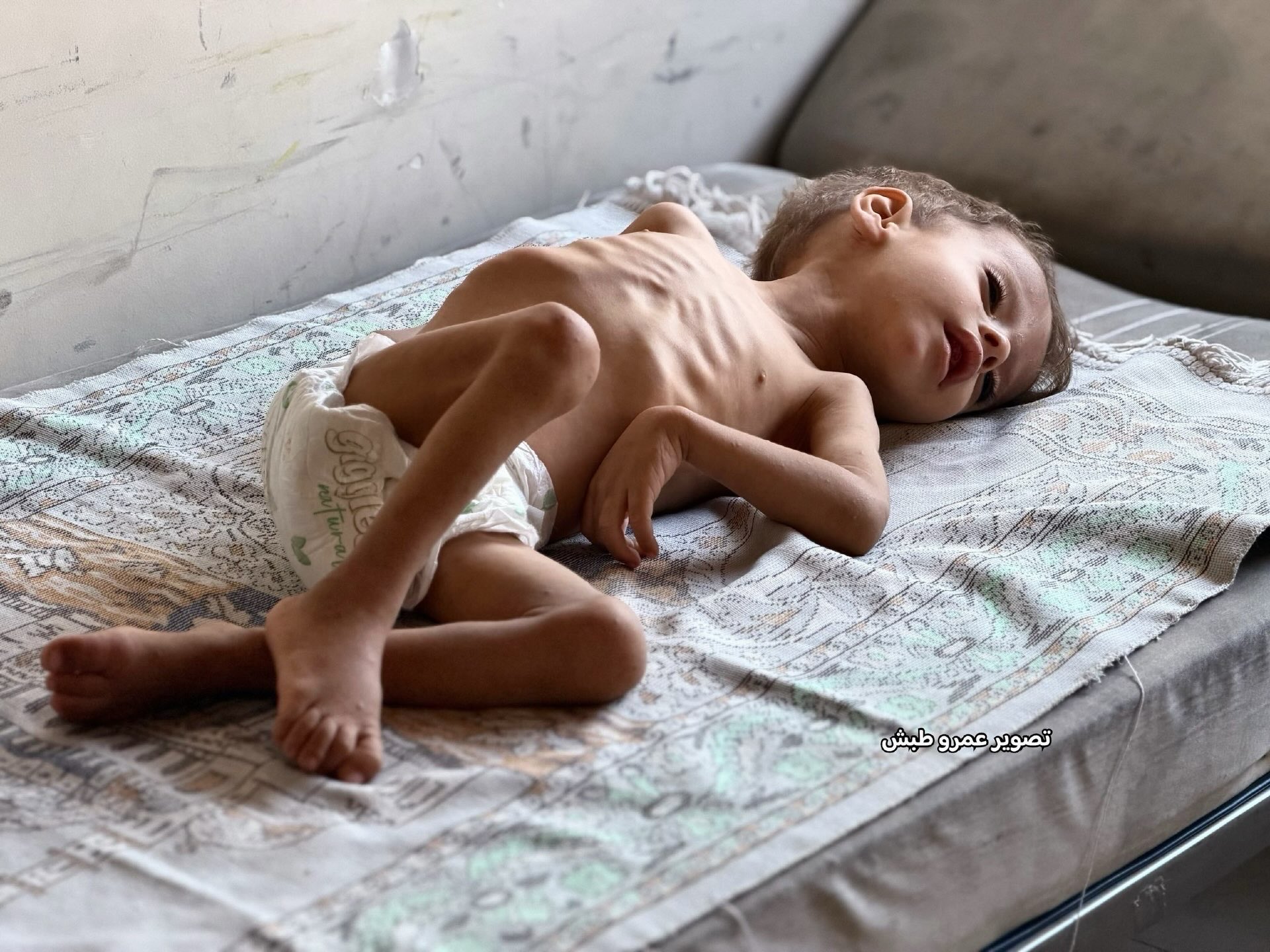 Toddler Hashem Abu Mustafa in critical condition from severe malnutrition
